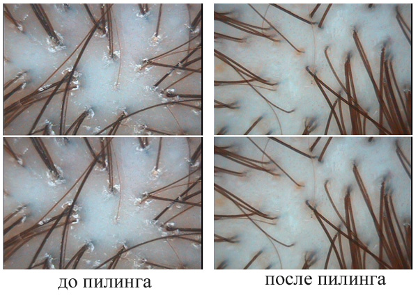 Эффективный пилинг кожи головы  